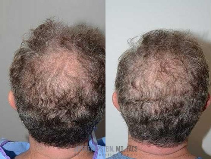 Before & After Hair Transplants For Men Case 153 View 2 View in Miami, FL