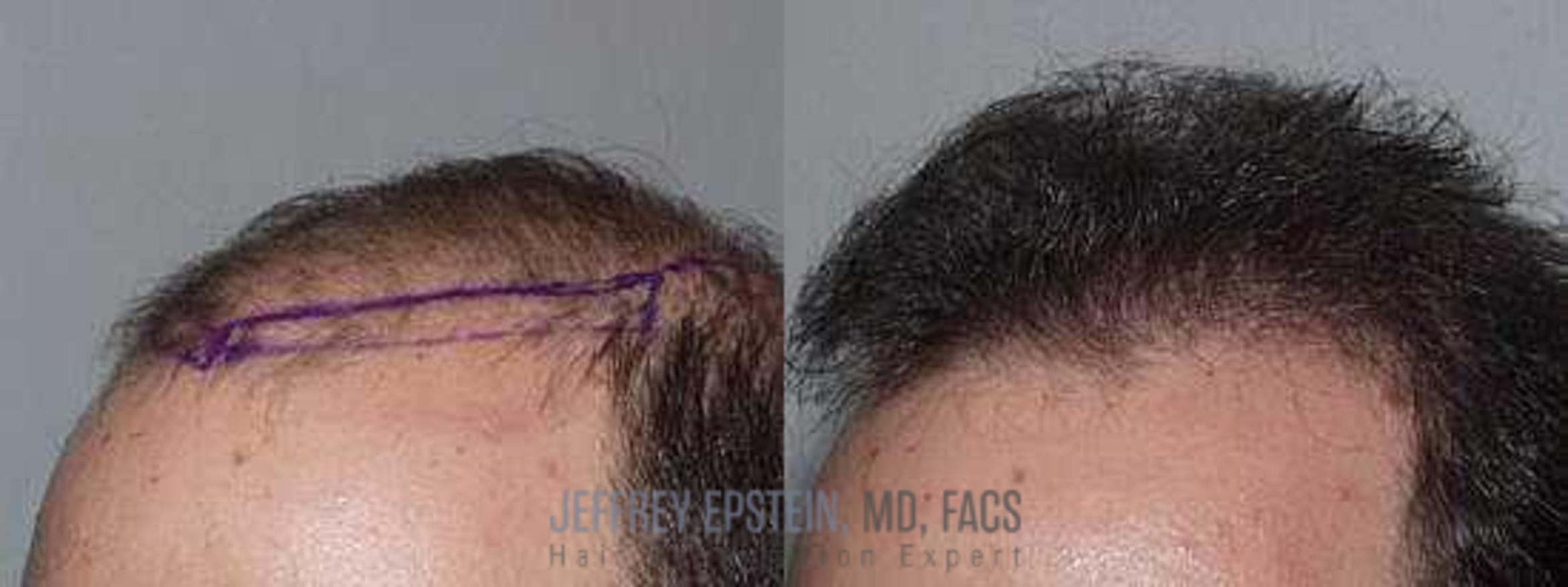 Before & After Hair Transplants For Men Case 155 View 1 View in Miami, FL