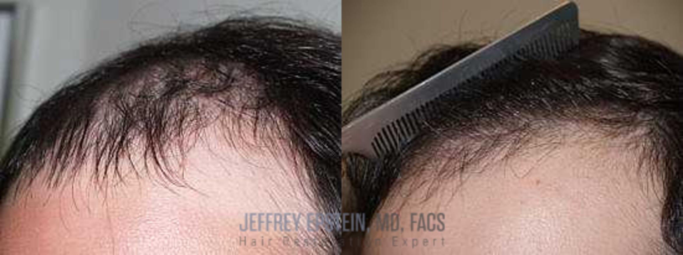 Before & After Hair Transplants For Men Case 155 View 2 View in Miami, FL