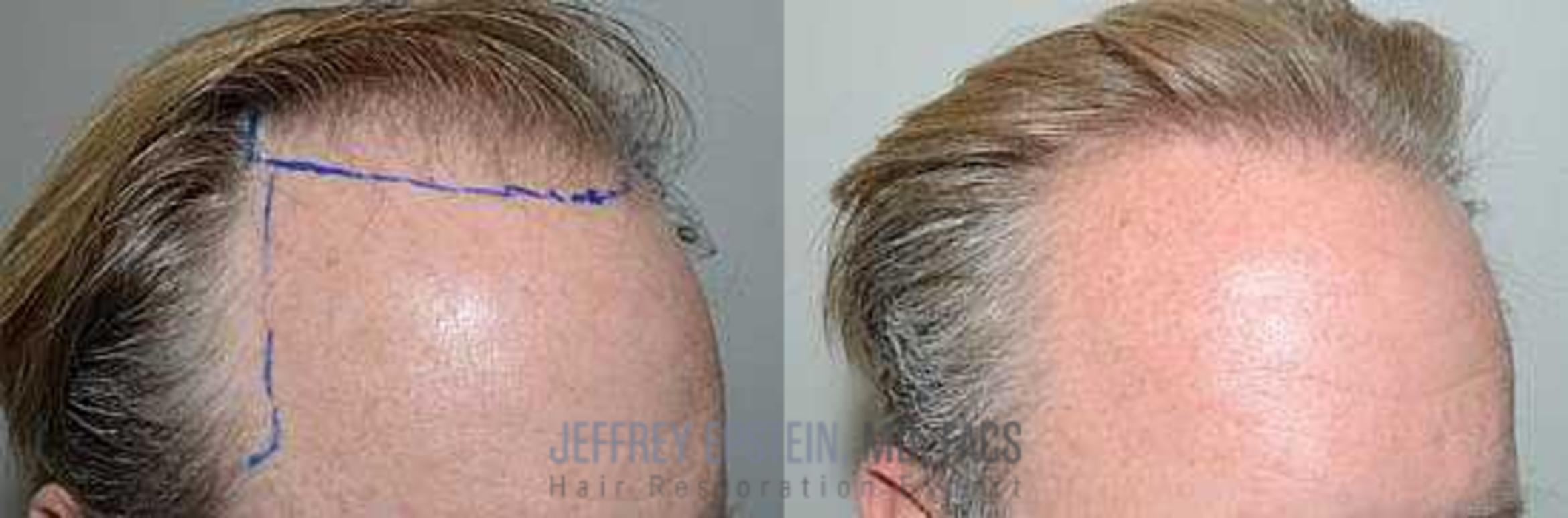 Before & After Hair Transplants For Men Case 156 View 1 View in Miami, FL
