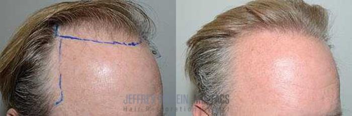 Before & After Hair Transplants For Men Case 156 View 1 View in Miami, FL