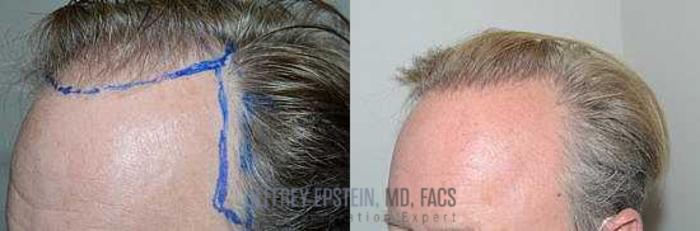 Before & After Hair Transplants For Men Case 156 View 2 View in Miami, FL