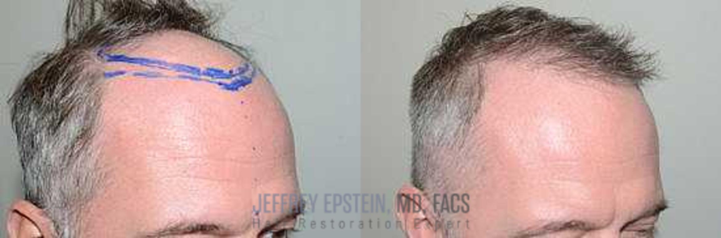 Before & After Hair Transplants For Men Case 157 View 1 View in Miami, FL