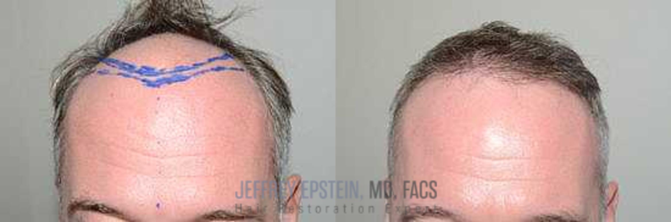 Before & After Hair Transplants For Men Case 157 View 2 View in Miami, FL