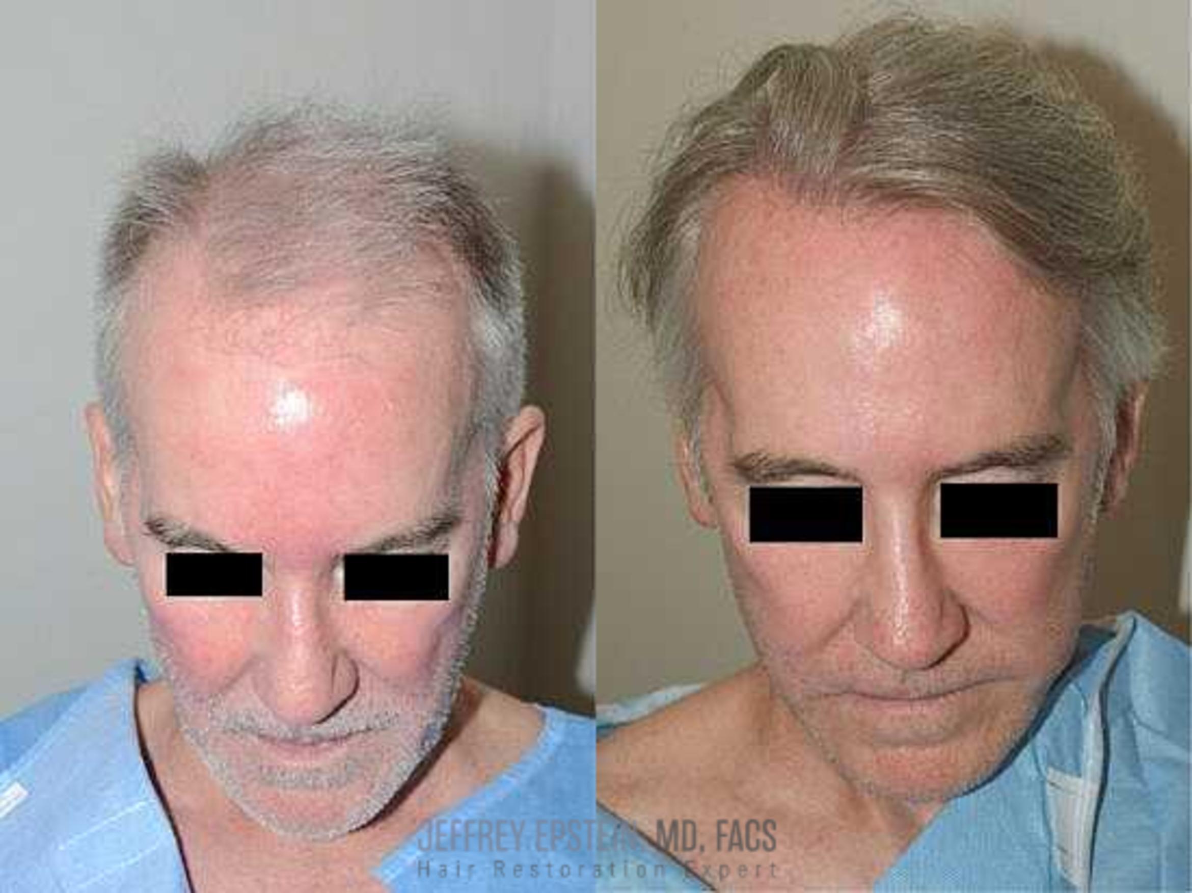 Before & After Hair Transplants For Men Case 16 View 1 View in Miami, FL