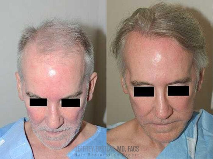 Before & After Hair Transplants For Men Case 16 View 1 View in Miami, FL