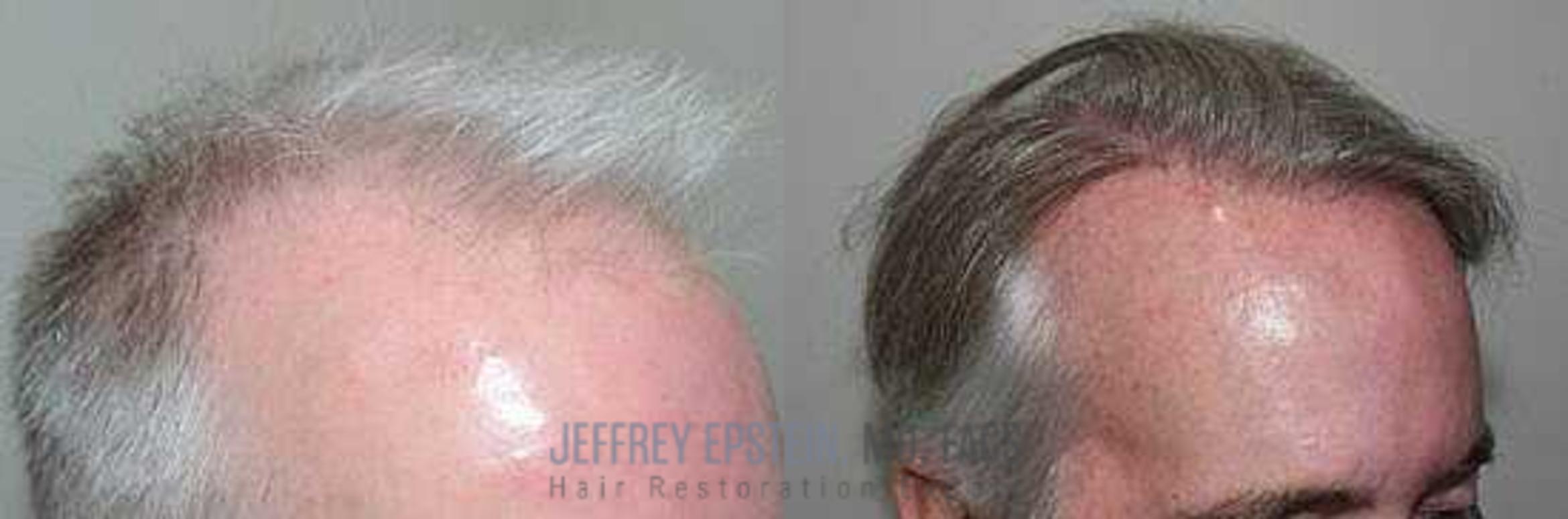 Before & After Hair Transplants For Men Case 16 View 2 View in Miami, FL