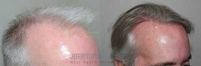Before & After Hair Transplants For Men Case 16 View 2 View in Miami, FL