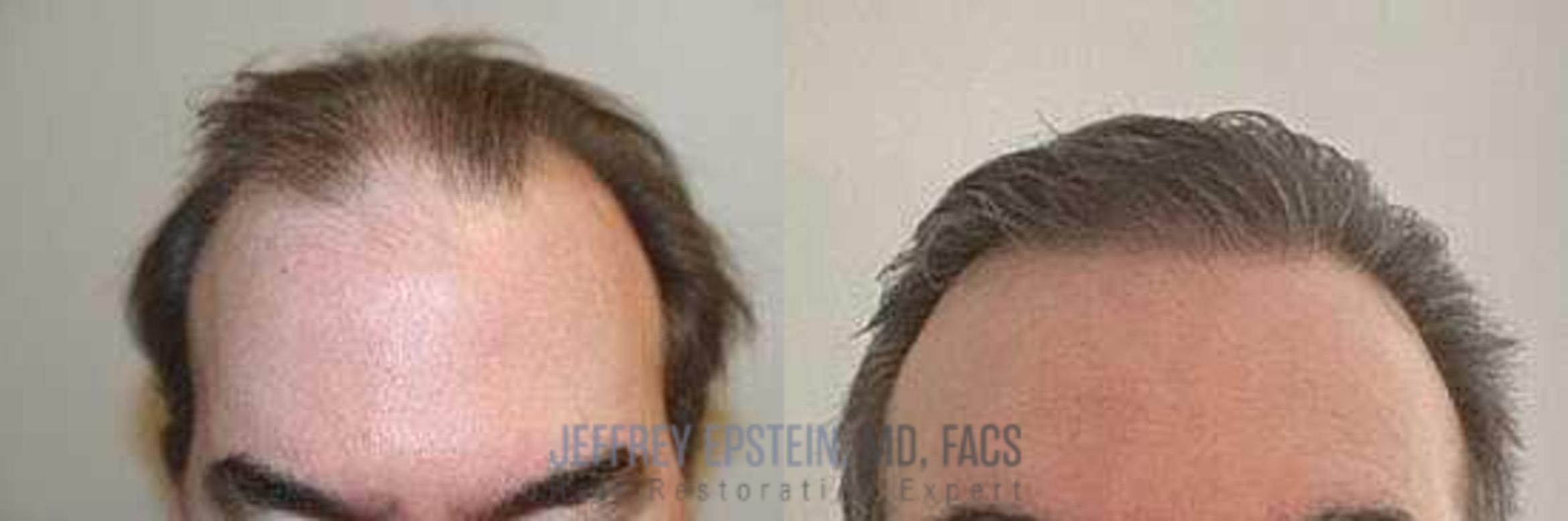 Before & After Hair Transplants For Men Case 17 View 1 View in Miami, FL
