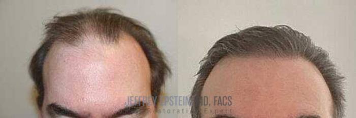 Before & After Hair Transplants For Men Case 17 View 1 View in Miami, FL