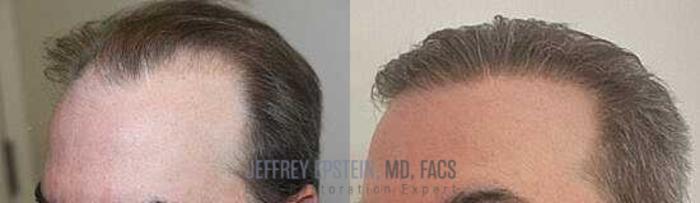 Before & After Hair Transplants For Men Case 17 View 2 View in Miami, FL
