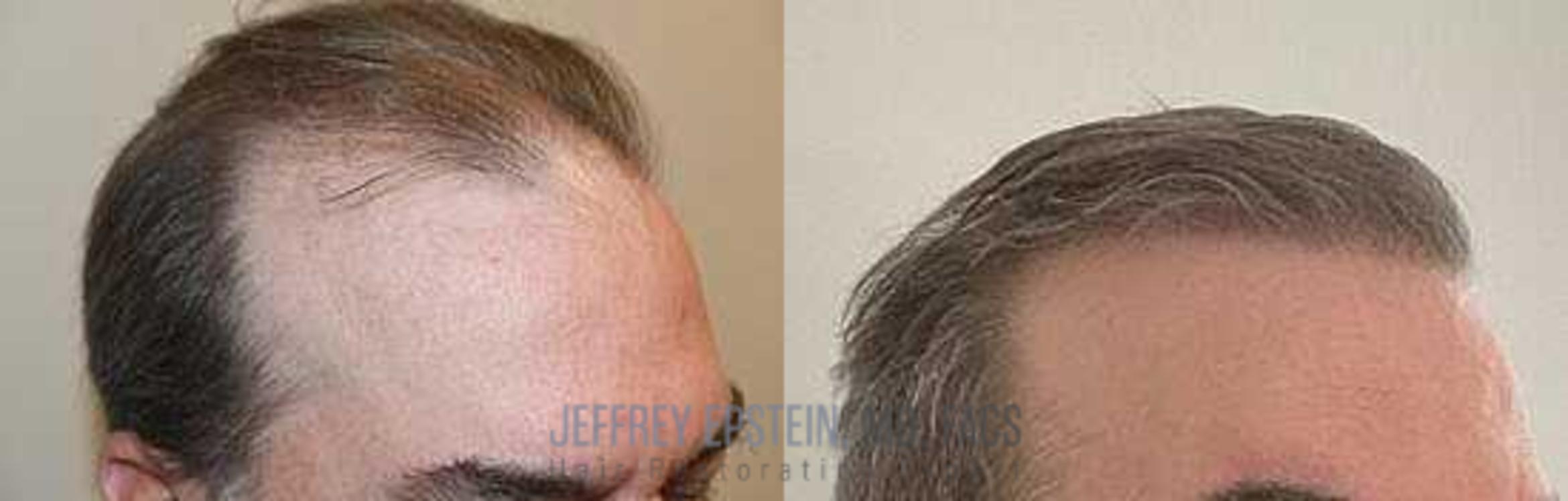 Before & After Hair Transplants For Men Case 17 View 3 View in Miami, FL