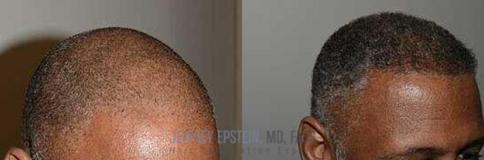 Before & After Hair Transplants For Men Case 18 View 1 View in Miami, FL
