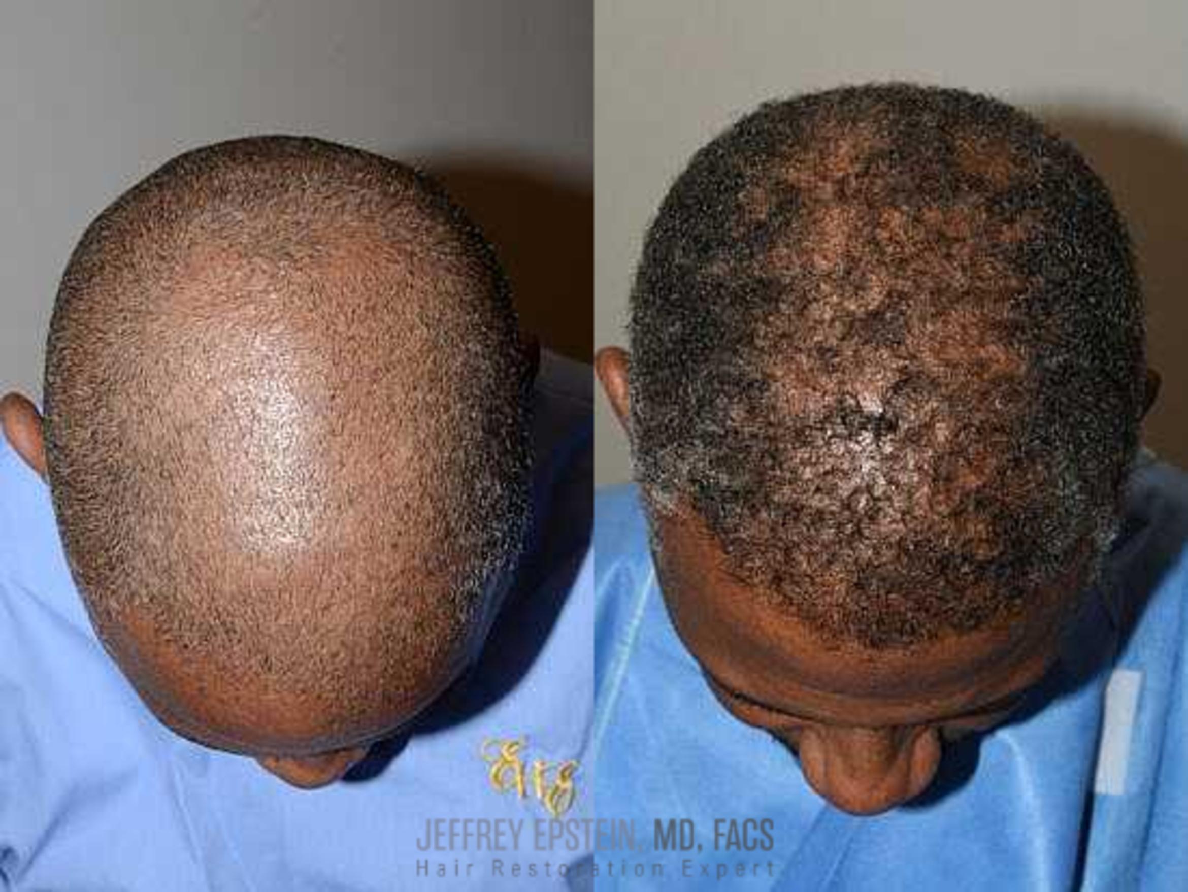 Before & After Hair Transplants For Men Case 18 View 2 View in Miami, FL