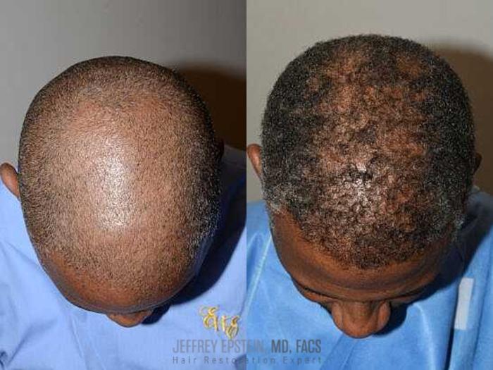 Before & After Hair Transplants For Men Case 18 View 2 View in Miami, FL