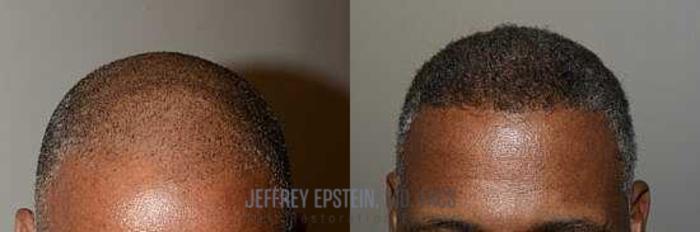 Before & After Hair Transplants For Men Case 18 View 3 View in Miami, FL