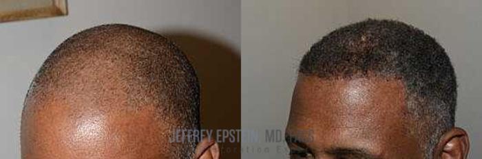 Before & After Hair Transplants For Men Case 18 View 4 View in Miami, FL