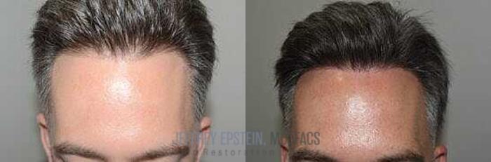Before & After Hair Transplants For Men Case 19 View 1 View in Miami, FL