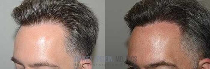 Before & After Hair Transplants For Men Case 19 View 2 View in Miami, FL