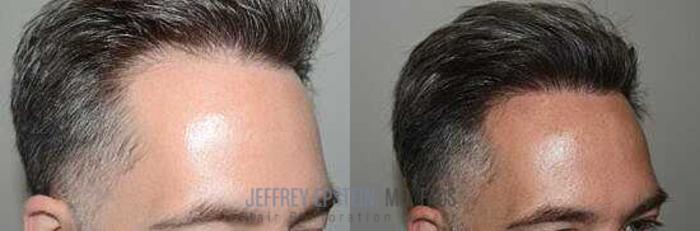 Before & After Hair Transplants For Men Case 19 View 3 View in Miami, FL