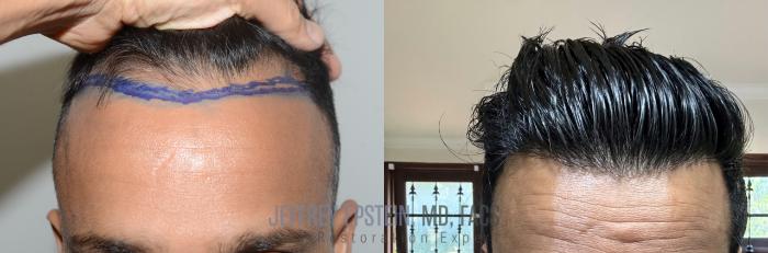 Before & After Hair Transplants For Men Case 2 Front View in Miami, FL