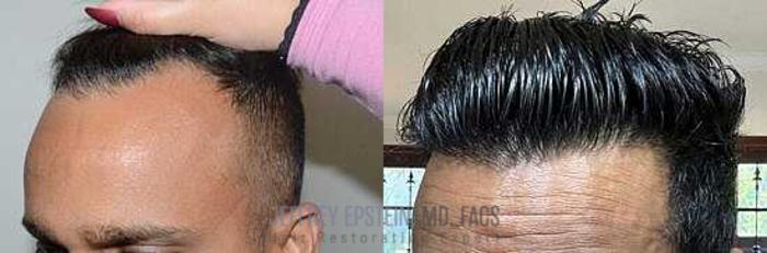 Before & After Hair Transplants For Men Case 2 View 2 View in Miami, FL