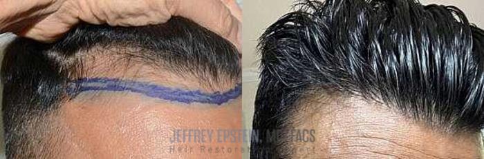 Before & After Hair Transplants For Men Case 2 View 3 View in Miami, FL
