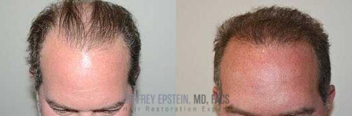 Before & After Hair Transplants For Men Case 20 View 1 View in Miami, FL