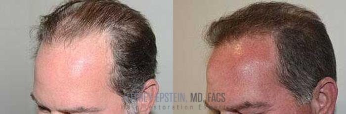 Before & After Hair Transplants For Men Case 20 View 2 View in Miami, FL