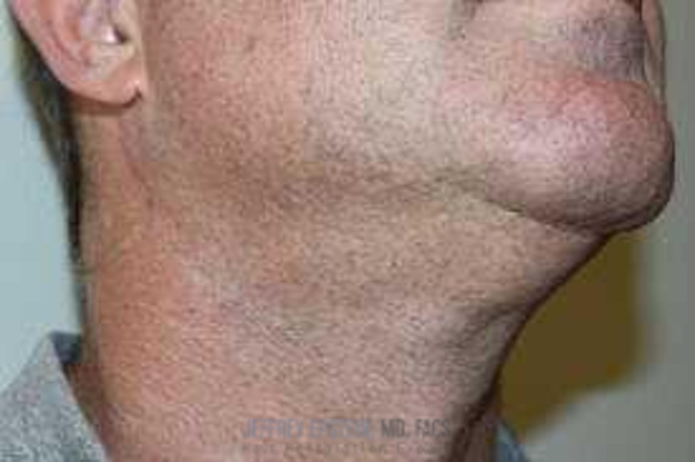 Before & After Hair Transplants For Men Case 20 View 3 View in Miami, FL