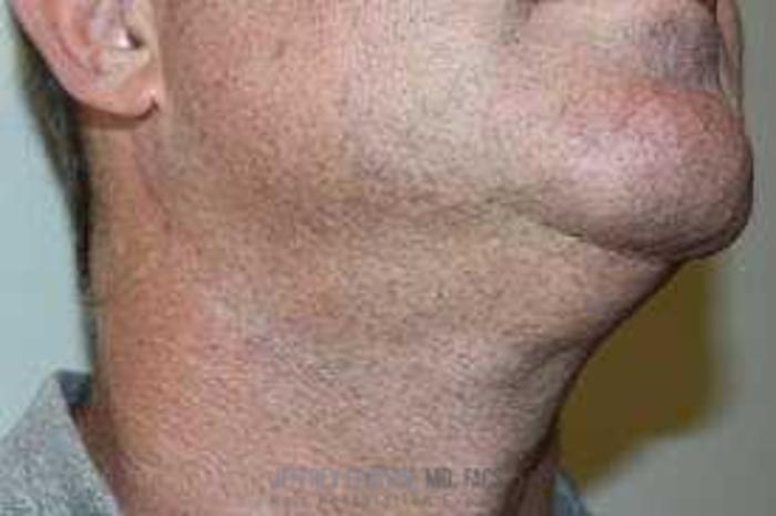 Before & After Hair Transplants For Men Case 20 View 3 View in Miami, FL