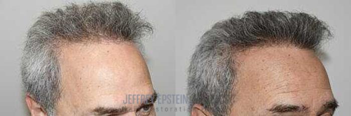Before & After Hair Transplants For Men Case 22 View 1 View in Miami, FL