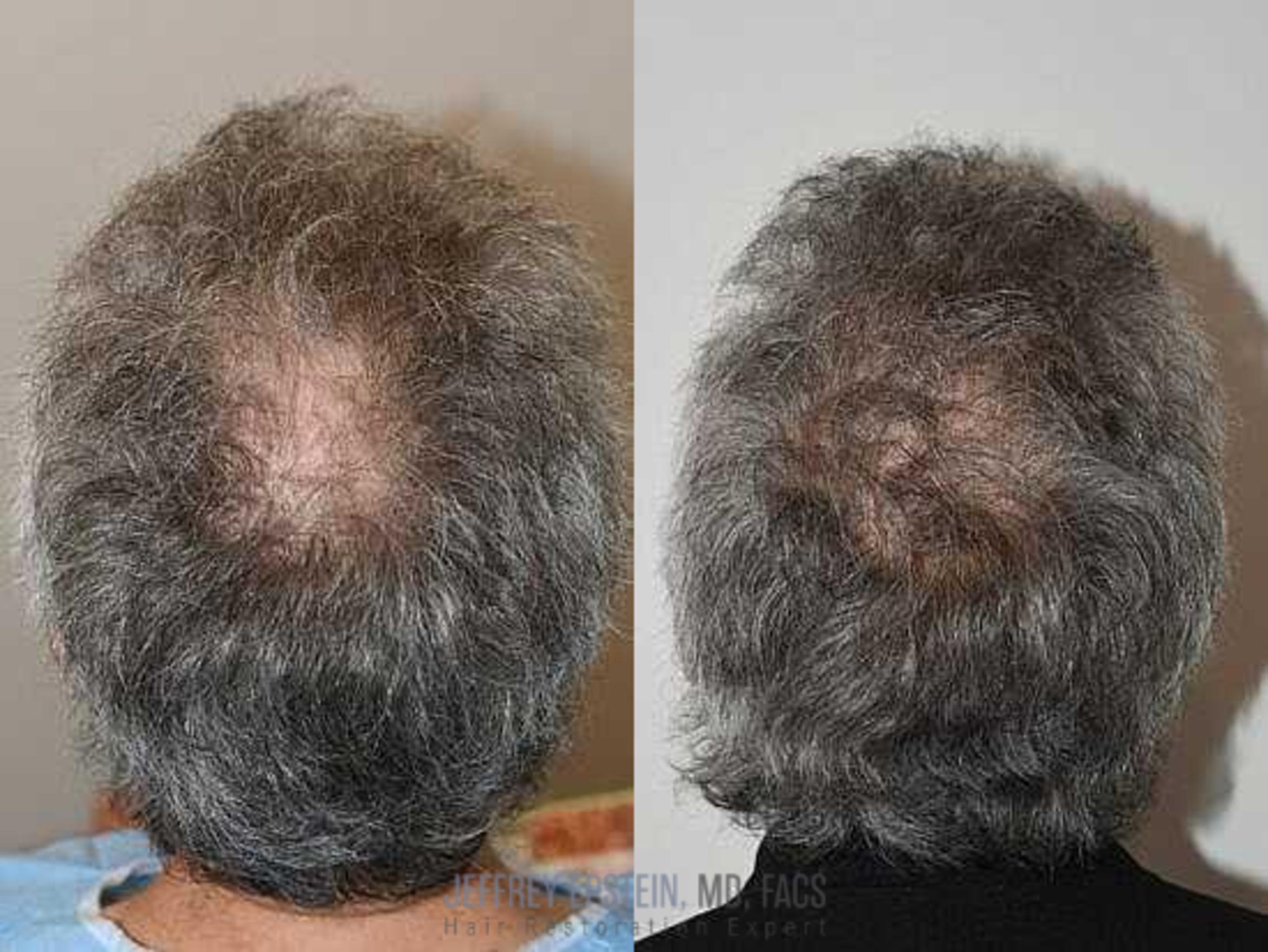Before & After Hair Transplants For Men Case 22 View 2 View in Miami, FL