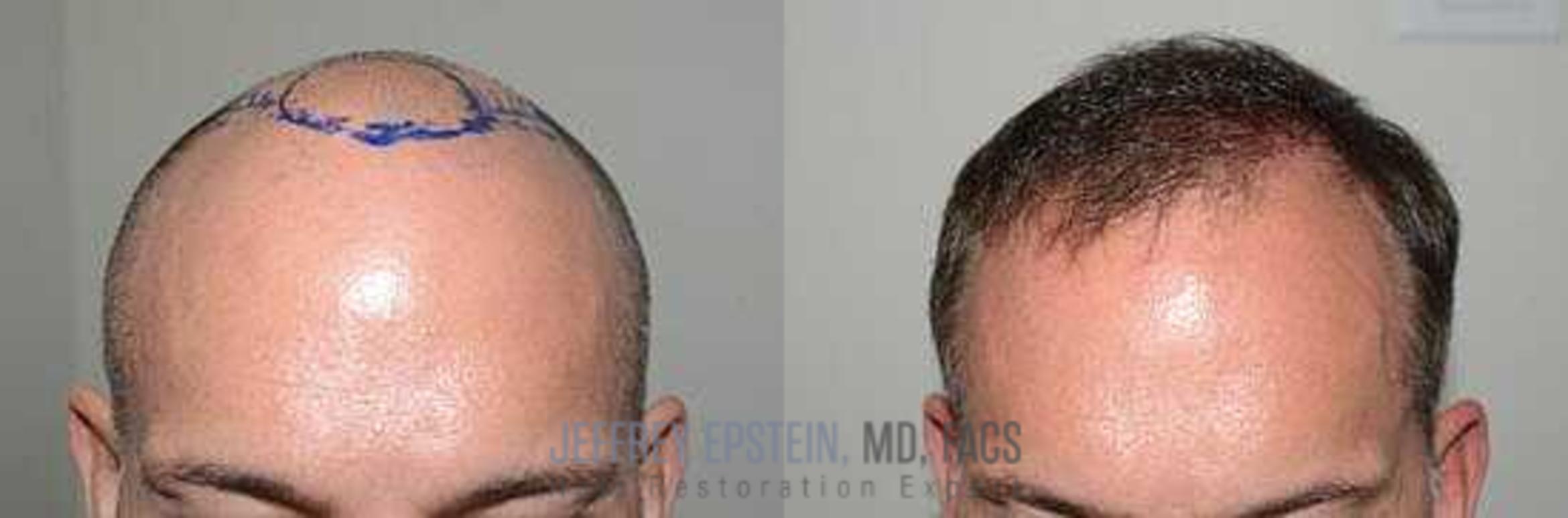 Before & After Hair Transplants For Men Case 23 View 1 View in Miami, FL
