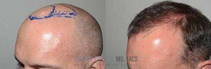 Before & After Hair Transplants For Men Case 23 View 2 View in Miami, FL