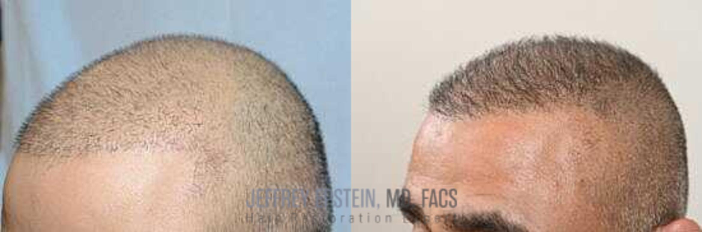 Before & After Hair Transplants For Men Case 25 View 1 View in Miami, FL
