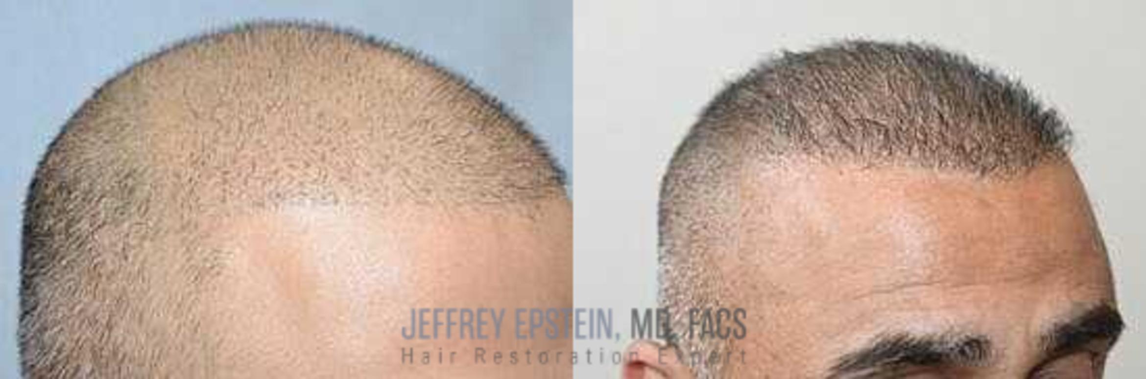Before & After Hair Transplants For Men Case 25 View 2 View in Miami, FL