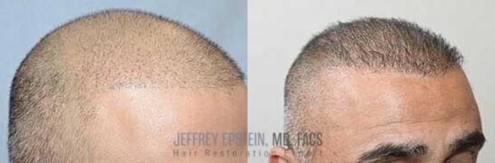 Before & After Hair Transplants For Men Case 25 View 2 View in Miami, FL