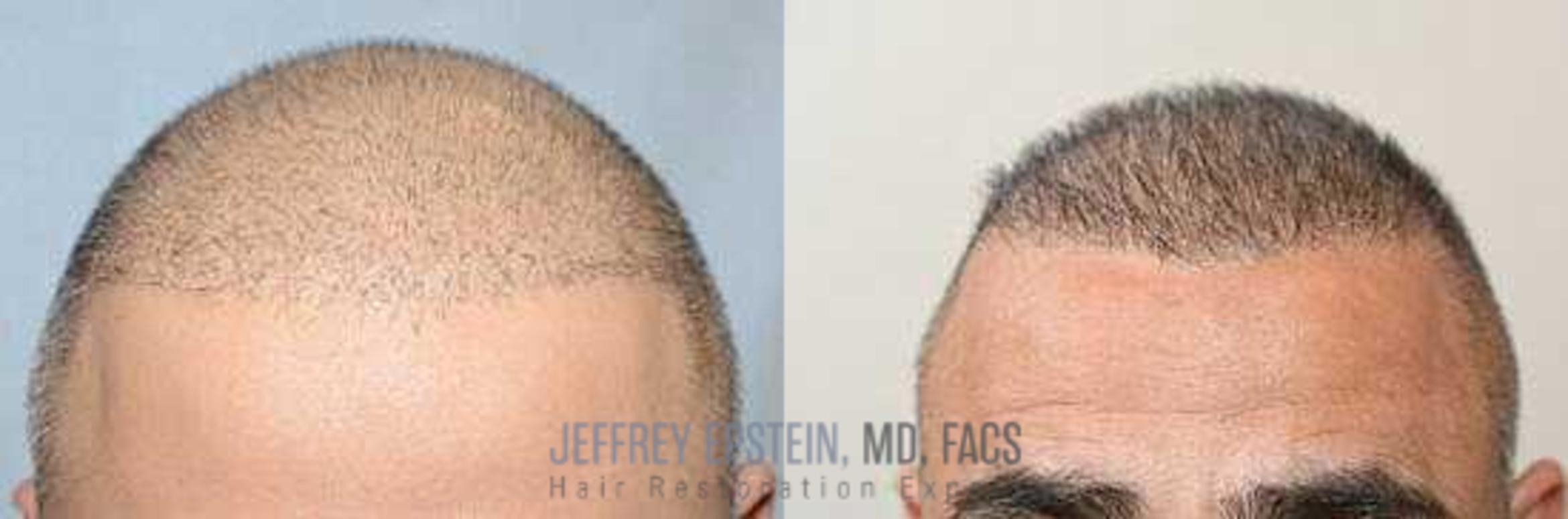 Before & After Hair Transplants For Men Case 25 View 3 View in Miami, FL