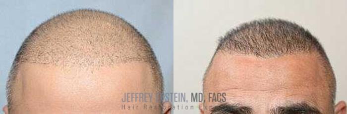Before & After Hair Transplants For Men Case 25 View 3 View in Miami, FL