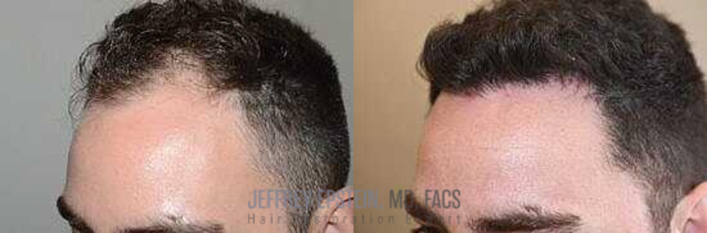 Before & After Hair Transplants For Men Case 27 View 1 View in Miami, FL