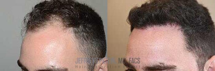 Before & After Hair Transplants For Men Case 27 View 1 View in Miami, FL