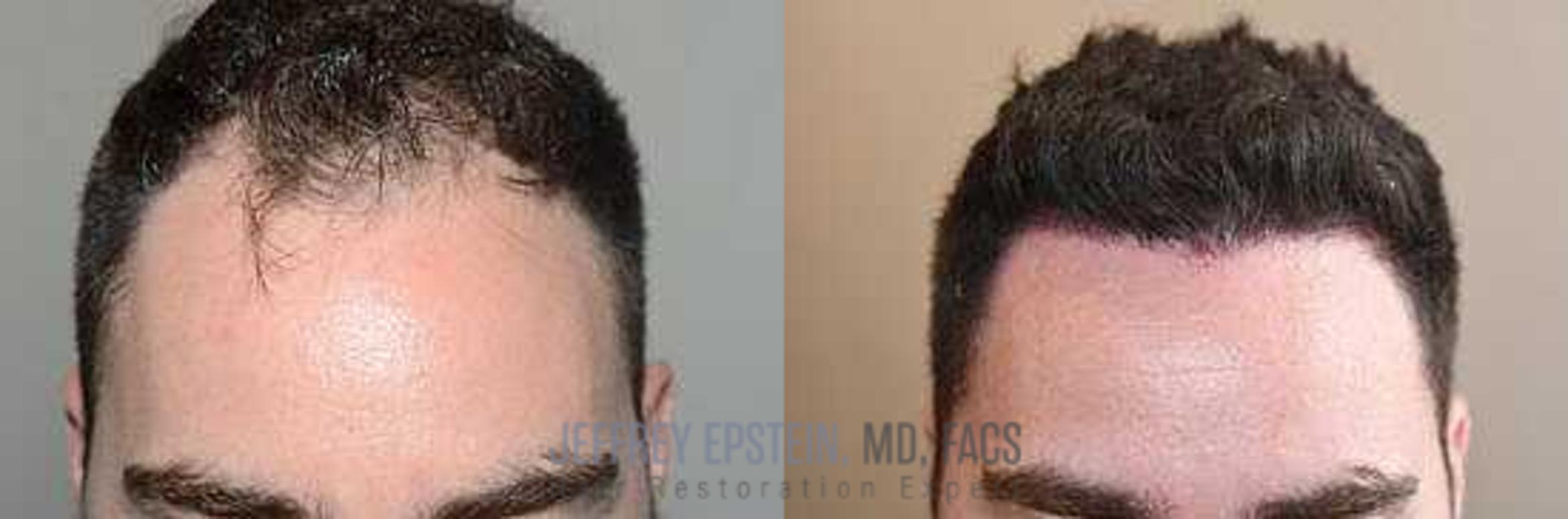 Before & After Hair Transplants For Men Case 27 View 2 View in Miami, FL