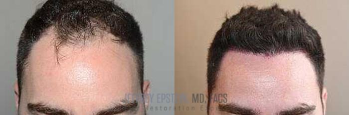 Before & After Hair Transplants For Men Case 27 View 2 View in Miami, FL
