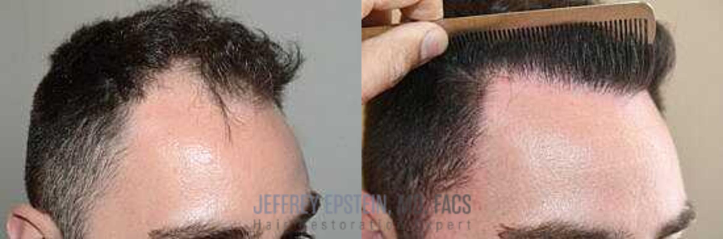 Before & After Hair Transplants For Men Case 27 View 3 View in Miami, FL