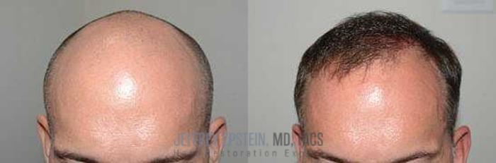Before & After Hair Transplants For Men Case 28 View 1 View in Miami, FL