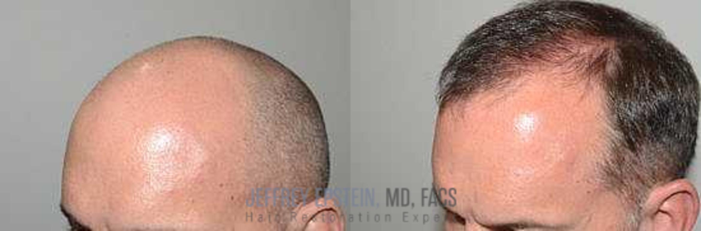 Before & After Hair Transplants For Men Case 28 View 2 View in Miami, FL
