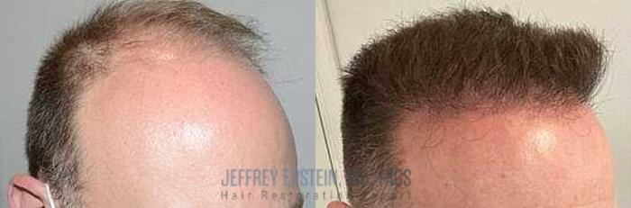 Before & After Hair Transplants For Men Case 3 View 1 View in Miami, FL