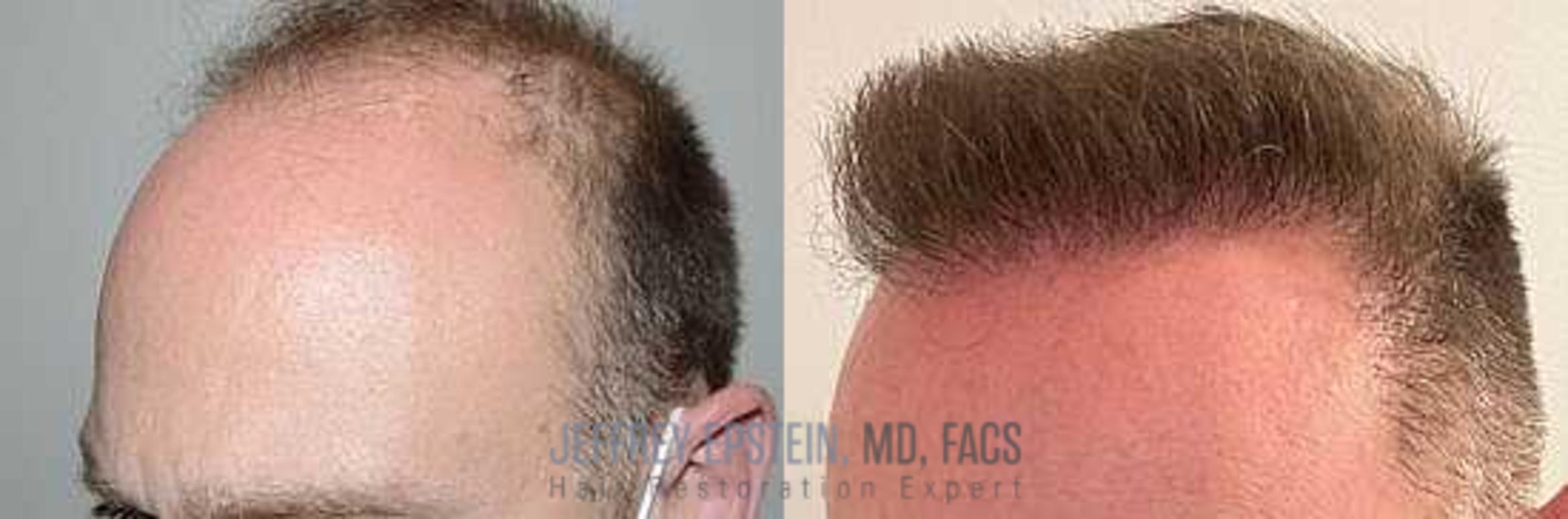 Before & After Hair Transplants For Men Case 3 View 2 View in Miami, FL