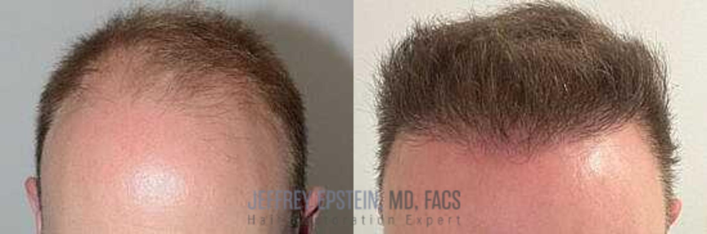 Before & After Hair Transplants For Men Case 3 View 3 View in Miami, FL